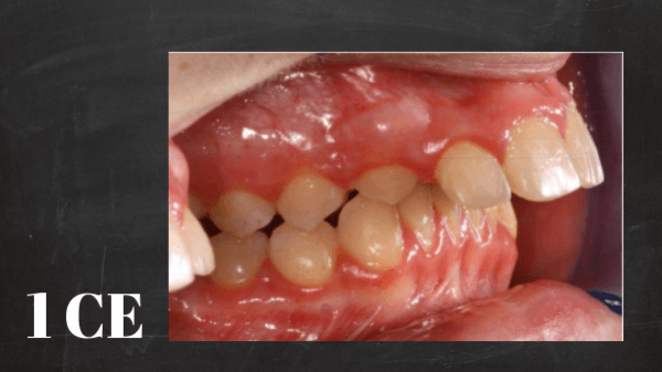 Angle’s Classification of Dental Malocclusion | ID#4000