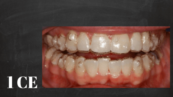 How to select orthodontic cases for clear aligner treatment | ID#4002