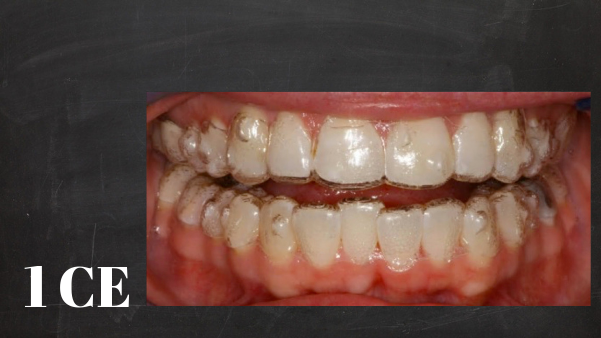 How to select orthodontic cases for clear aligner treatment | ID#4002 course image