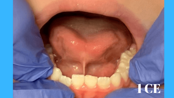 Tongue-Tie Assessment and Treatment | ID#4008 course image