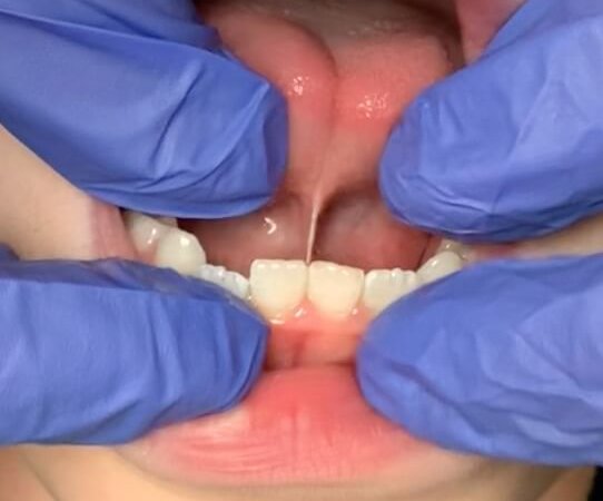 Tongue-Tie Assessment and Treatment | ID#4008