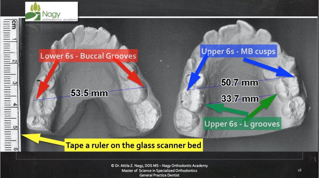 Digitizing Orthodontic Study Models With A Flatbed Scanner – Model ...