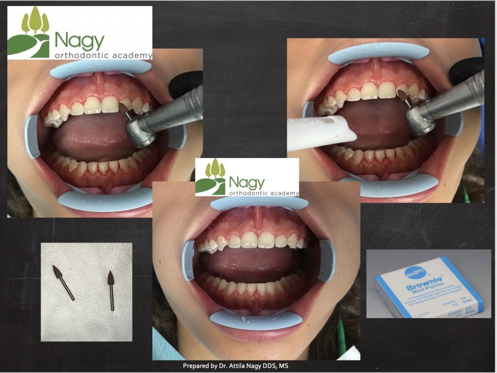 How to remove orthodontic cement and Invisalign attachments – Nagy